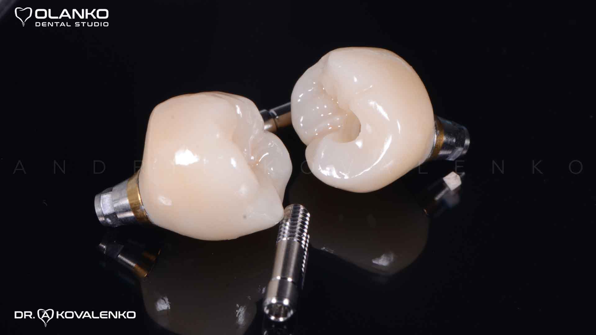Клинический случай 6 имплантация зубов