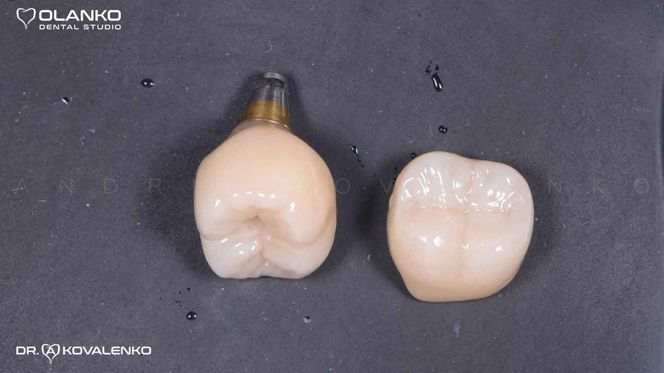 Имплантация зуба этапы до и после Оланко Бровары Киев
