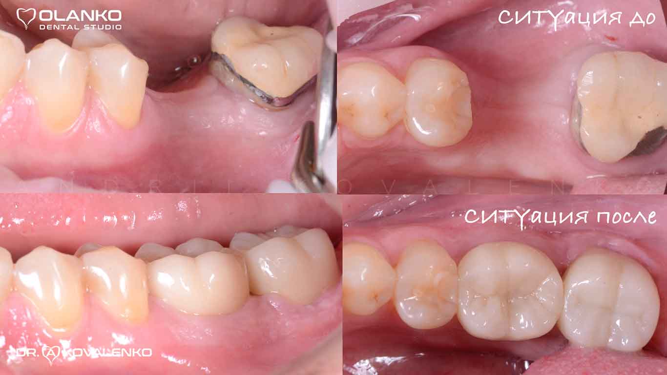Керамическая коронка установлена (имплантация зубов фото до и после) Оланко Киев Бровары