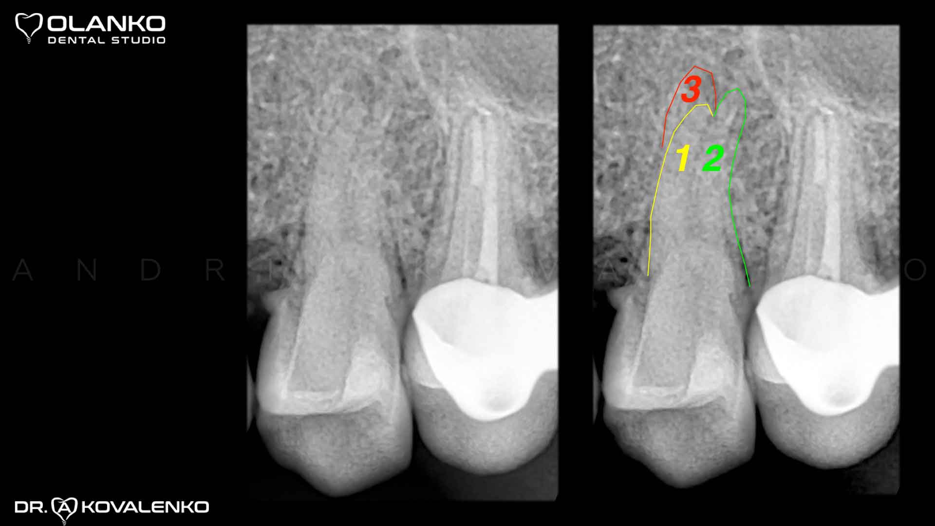Клинический случай 3 зубной канал
