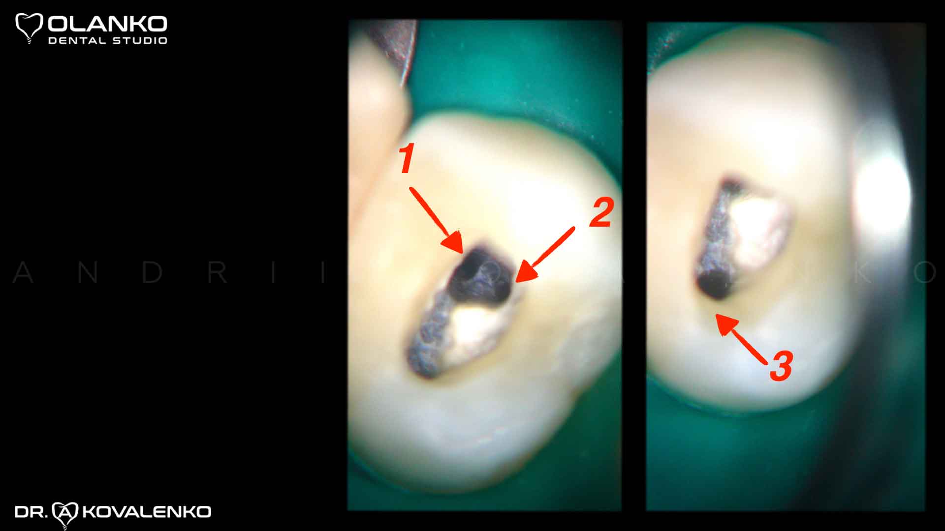 Клинический случай 3 зубной канал