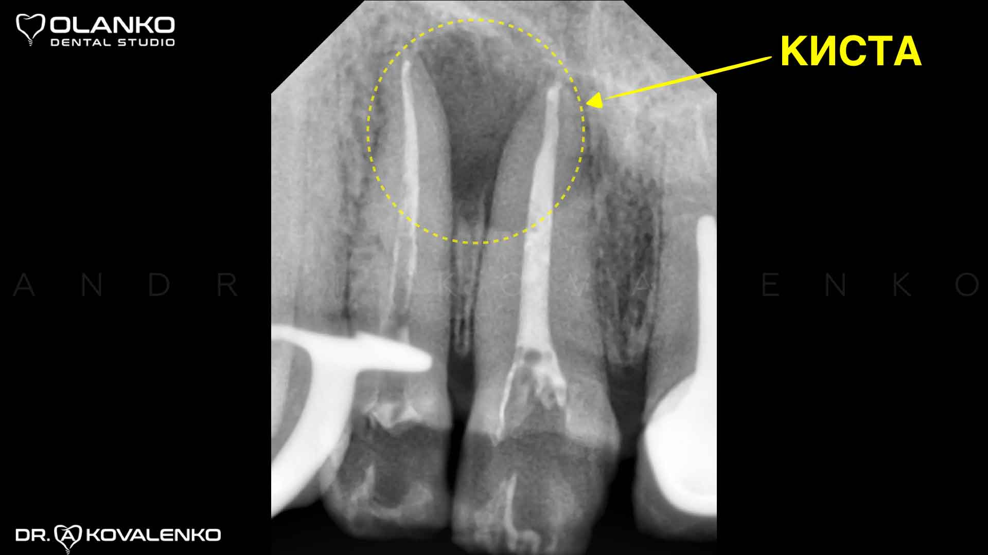 Пример лечение кисты переднего верхнего зуба