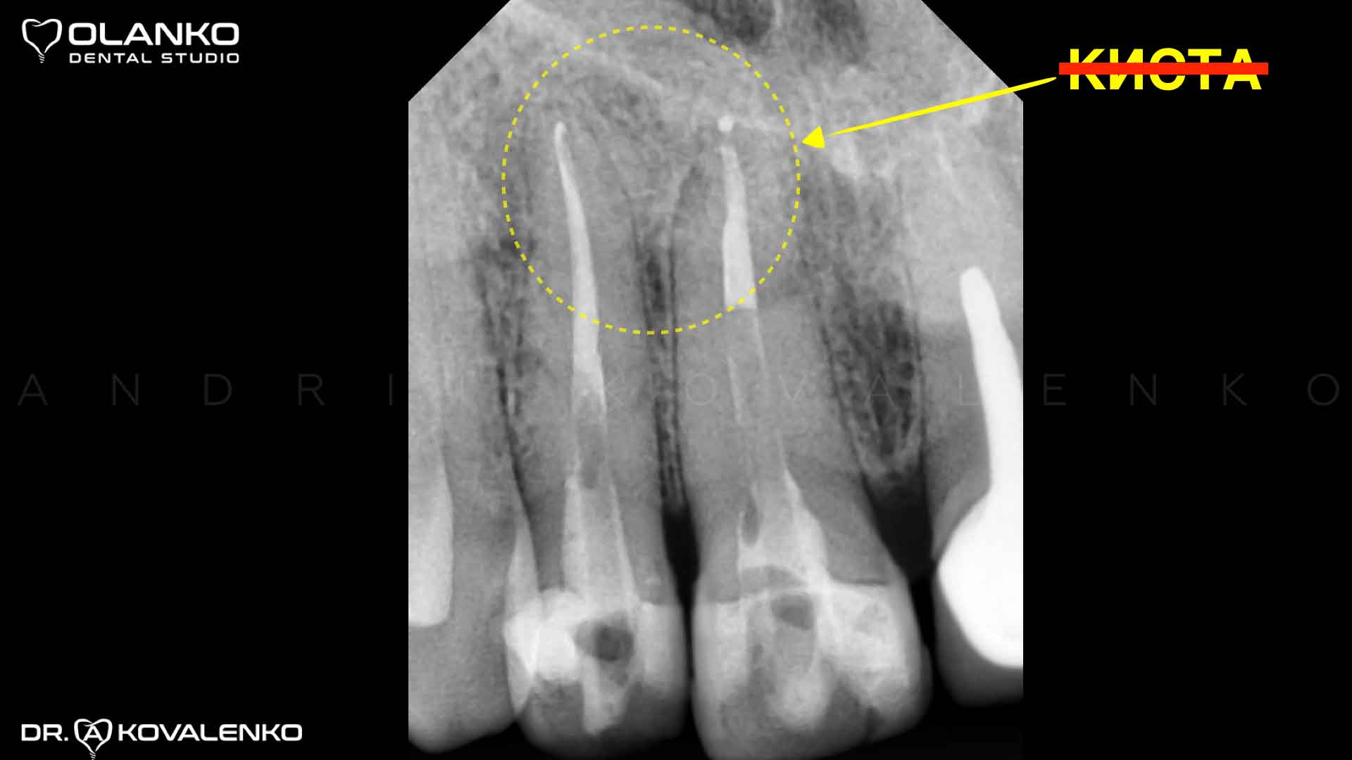 Пример лечение кисты переднего верхнего зуба