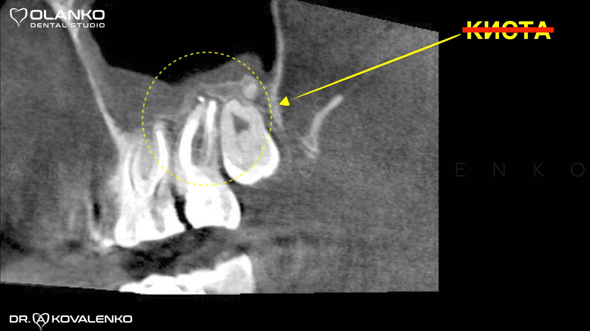 Пример лечения кисты верхнего жевательного зуба