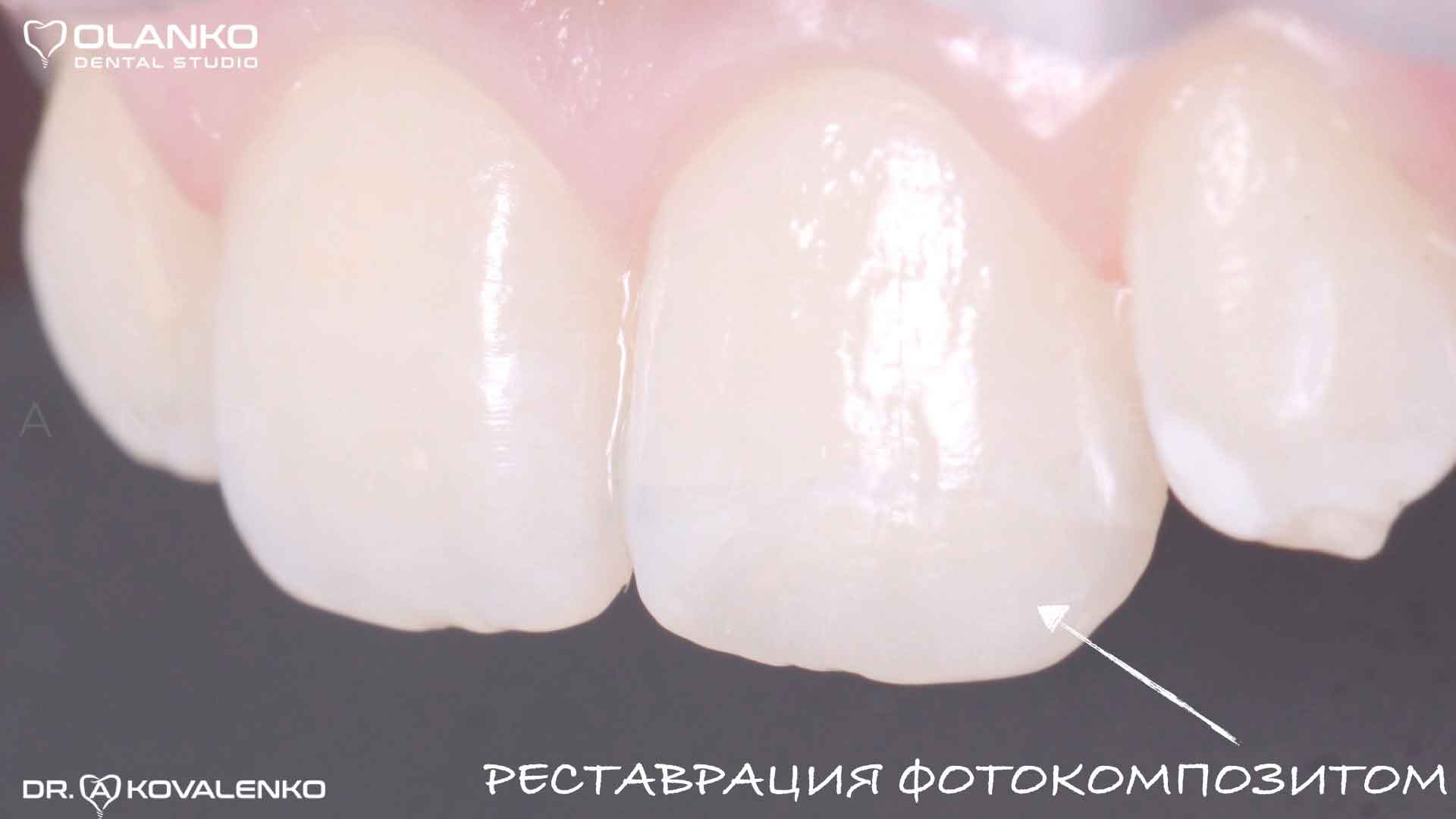 Фото переднего зуба после проведения реставрации фотокомпозитом Оланко