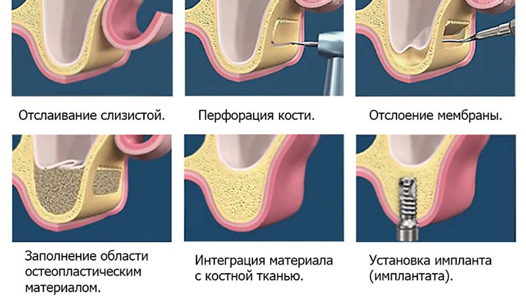 Наращивание кости для имплантов Оланко Бровары Киев