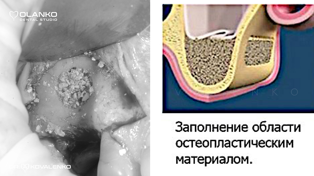 Наращивание костной ткани на нижней челюсти Оланко Бровары Киев