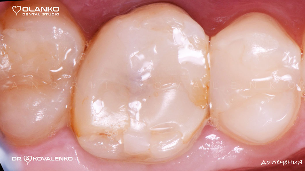 Результат реставрации зуба с использованием микроскопа Оланко