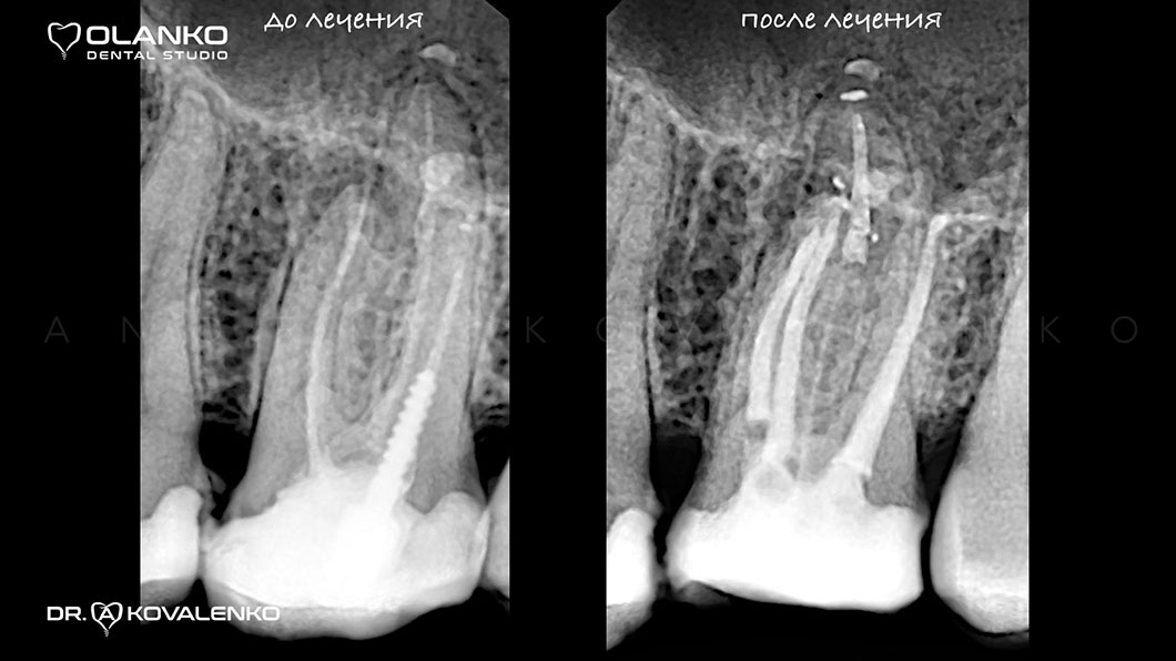 Рентген контроль пломбировки зубных каналов Киев Бровары Оланко
