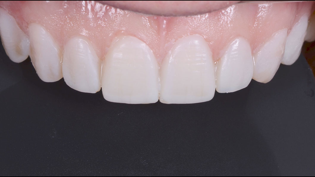 Перенос новой формы зубов (макета) на зубы и повторная фотосессия для анализа результата