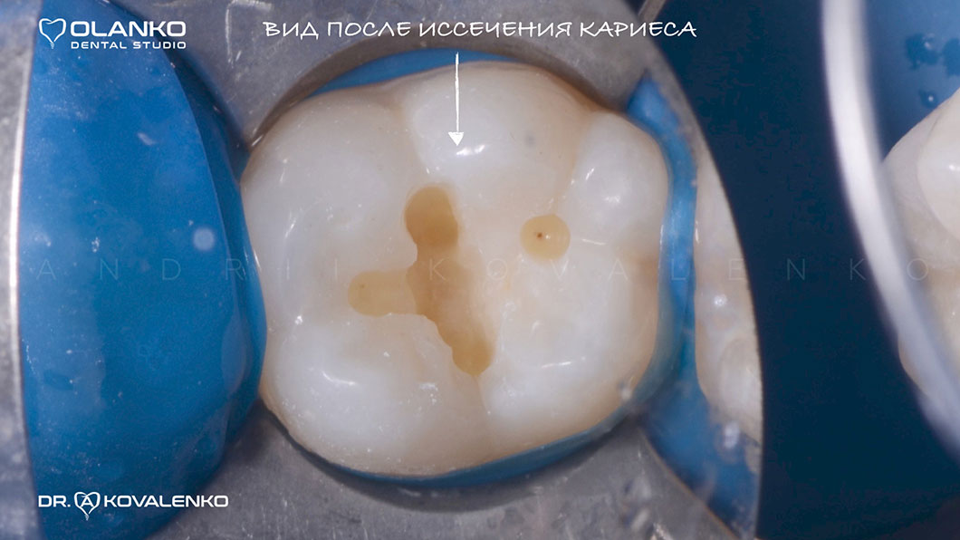 Зуб с кариесом после чистки - Оланко