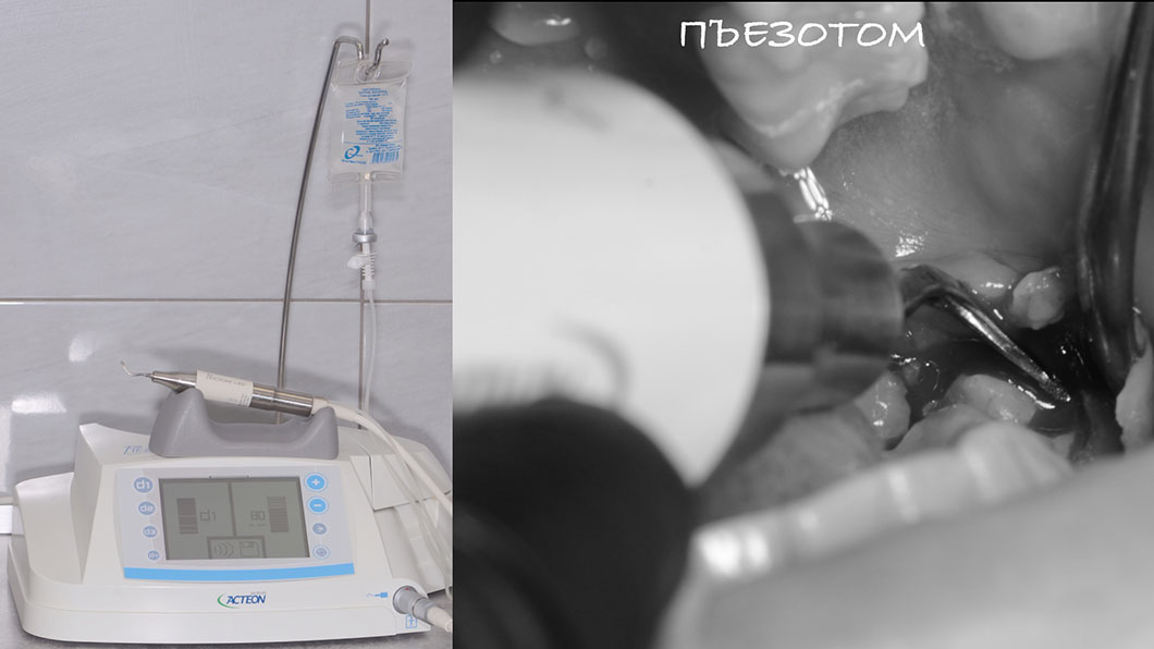 Фото ультразвукового аппарата для удаления сложных зубов Оланко Бровары Киев